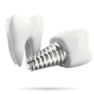 Імплантація зубів