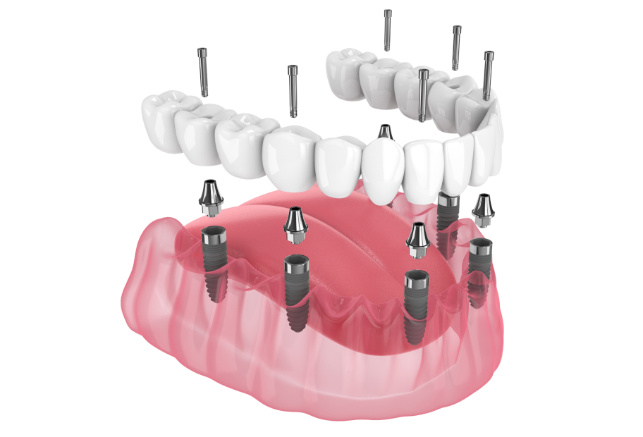 Імплантація зубів