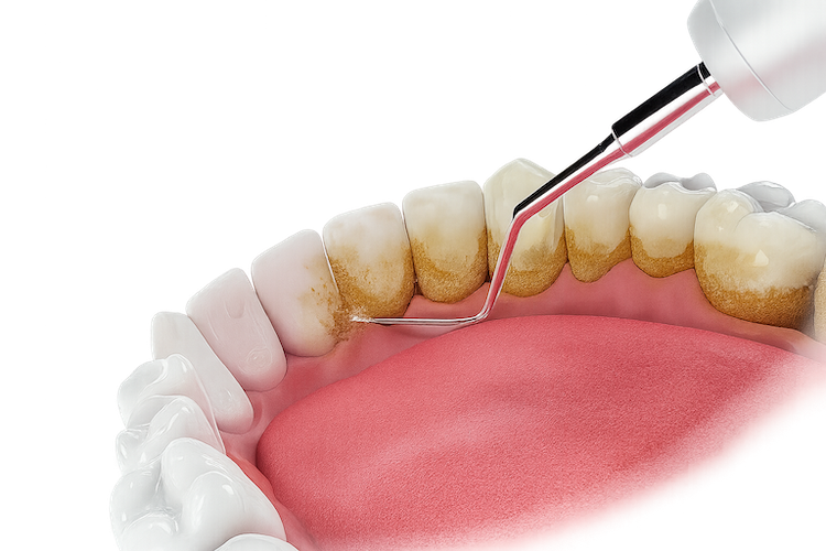 Імплантація зубів