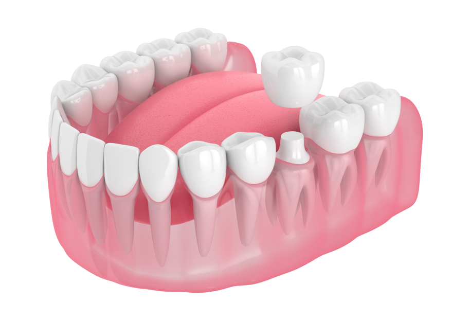 Імплантація зубів