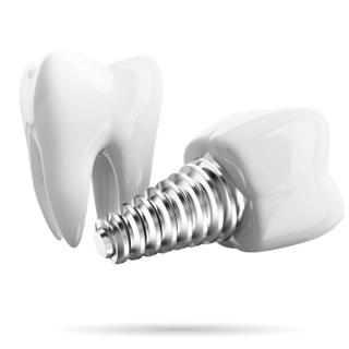 Імплантація зубів