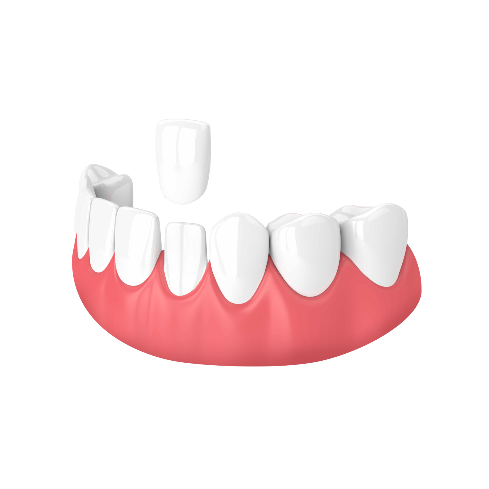 Імплантація зубів