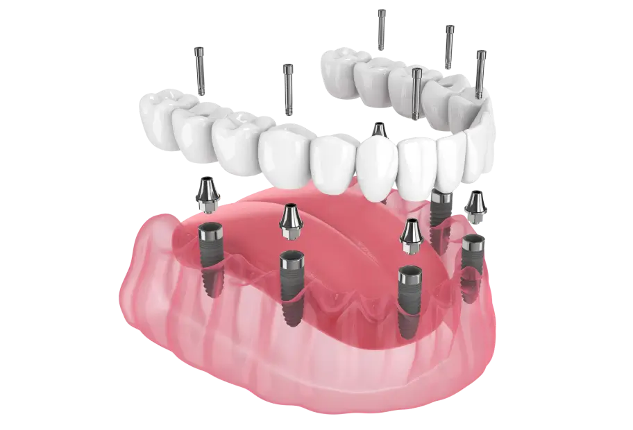 Імплантація зубів