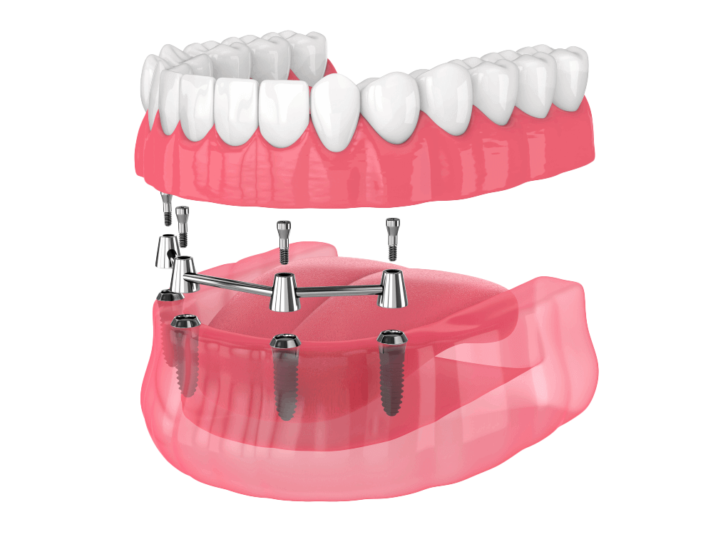 Імплантація зубів