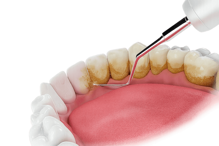 Імплантація зубів