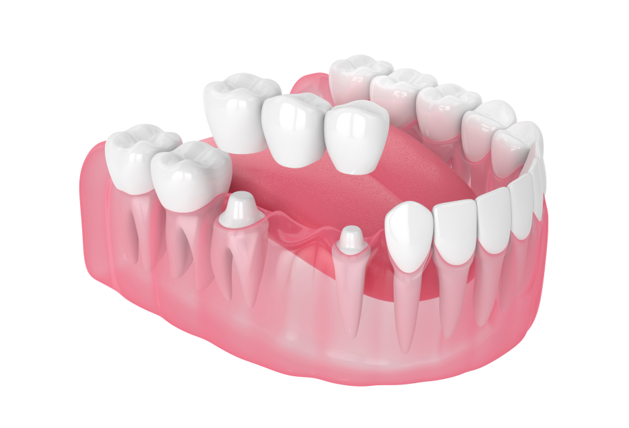 Імплантація зубів