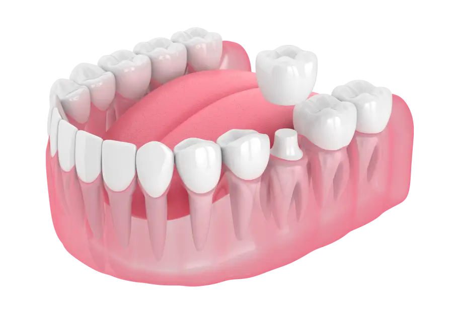 Імплантація зубів