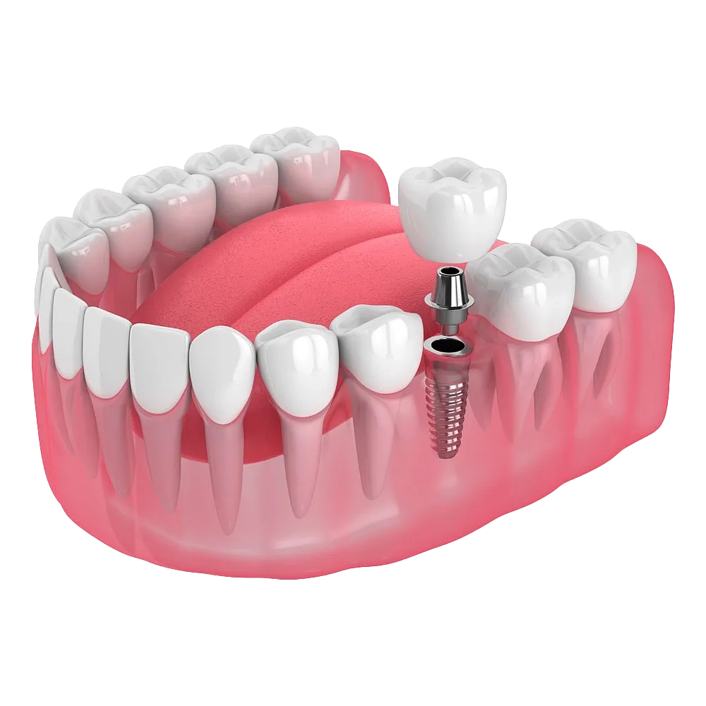 Імплантація зубів